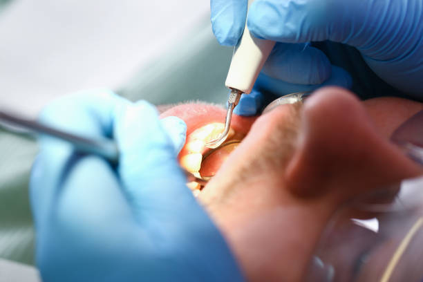 Best Emergency Wisdom Tooth Extraction in Palermo, NJ